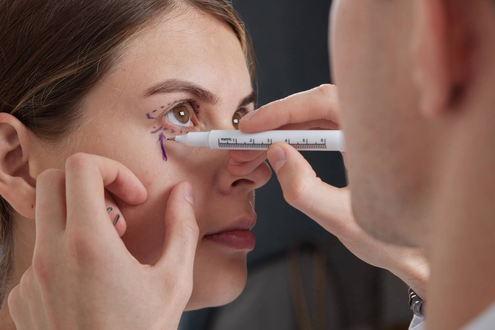 La blépharoplastie peut-elle corriger les poches sous les yeux ?