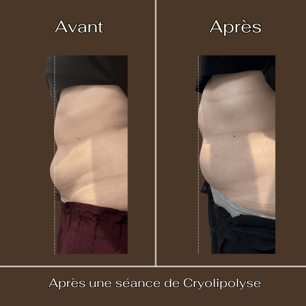 Cryolipolyse : Ventre | Avant/Après