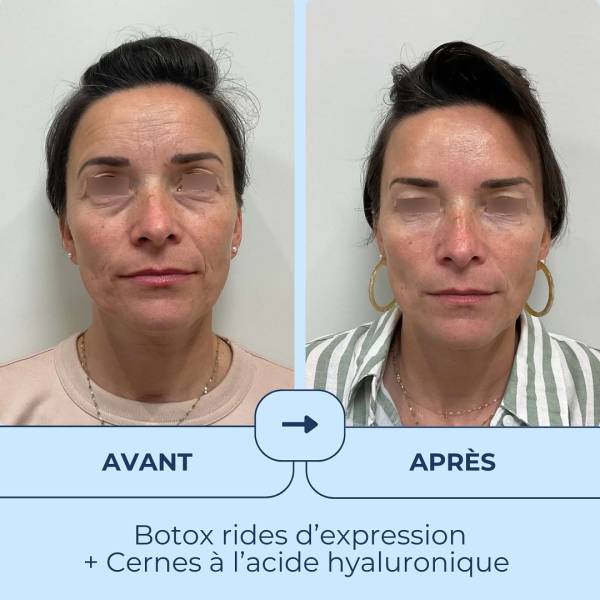 Botox pour rides d’expression avant / après dans notre centre esthétique proche de Marseille