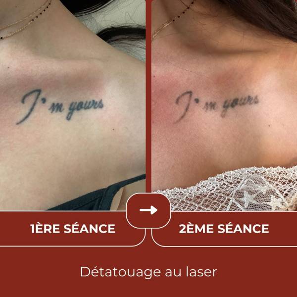 Se débarrasser d’un vieux tatouage avant/après dans notre centre à Aubagne