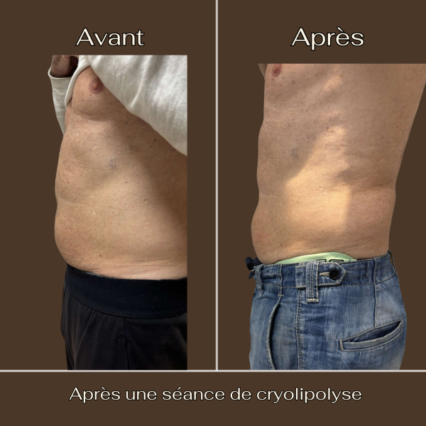 Cryolipolyse : Ventre | Avant/Après