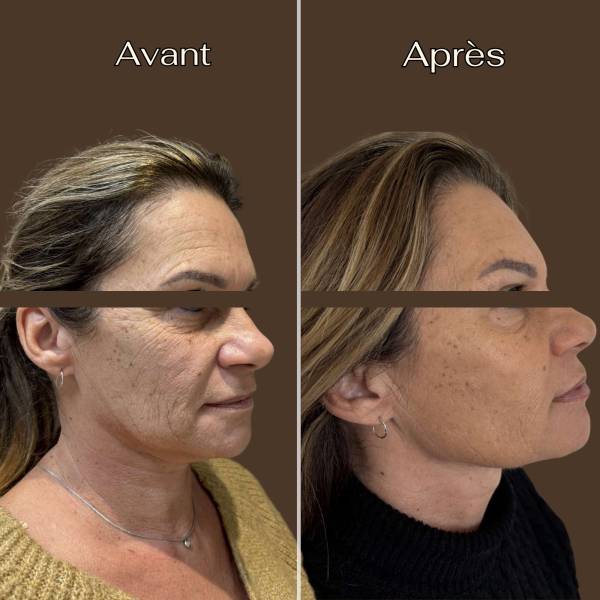 Fils tenseurs : Ovale du visage | Avant/Après