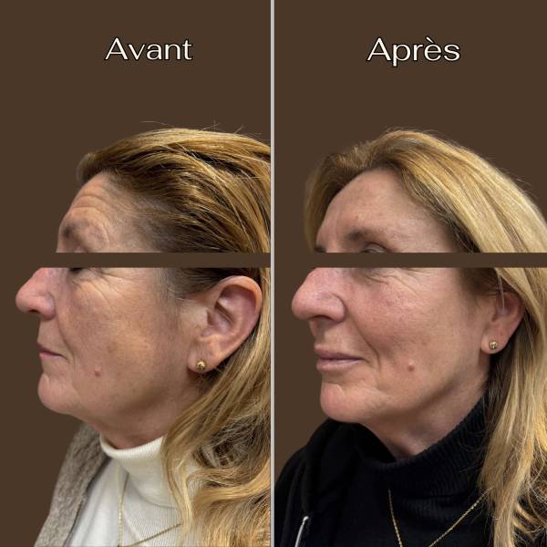 Injection acide hyaluronique : Full face | Avant/Après