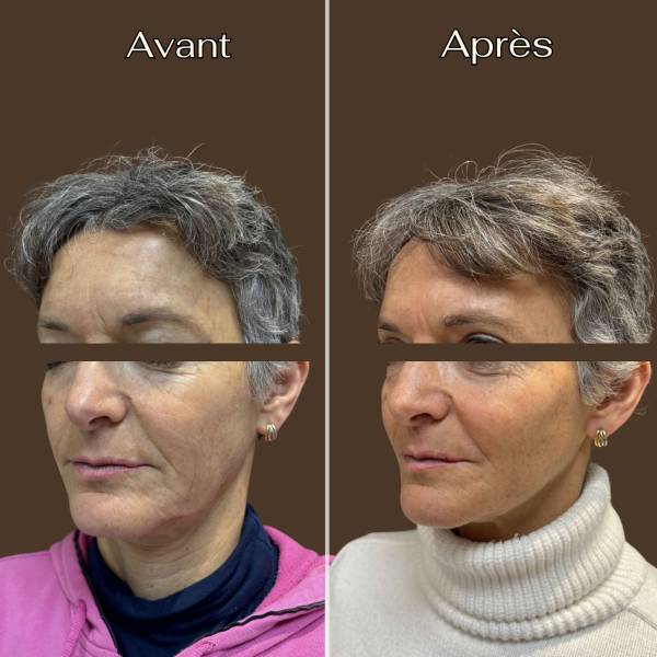 Fils tenseurs : Ovale du visage | Avant/Après