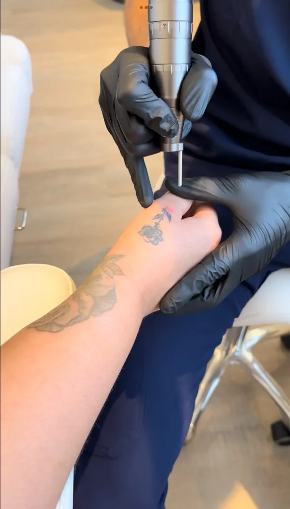 Séance de détatouage laser sur un tatouage du poignet