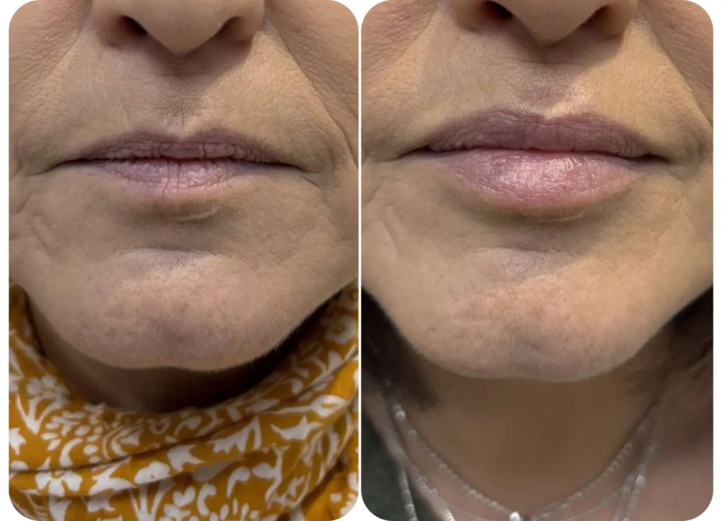 Traitement lèvres acide hyaluronique avant après