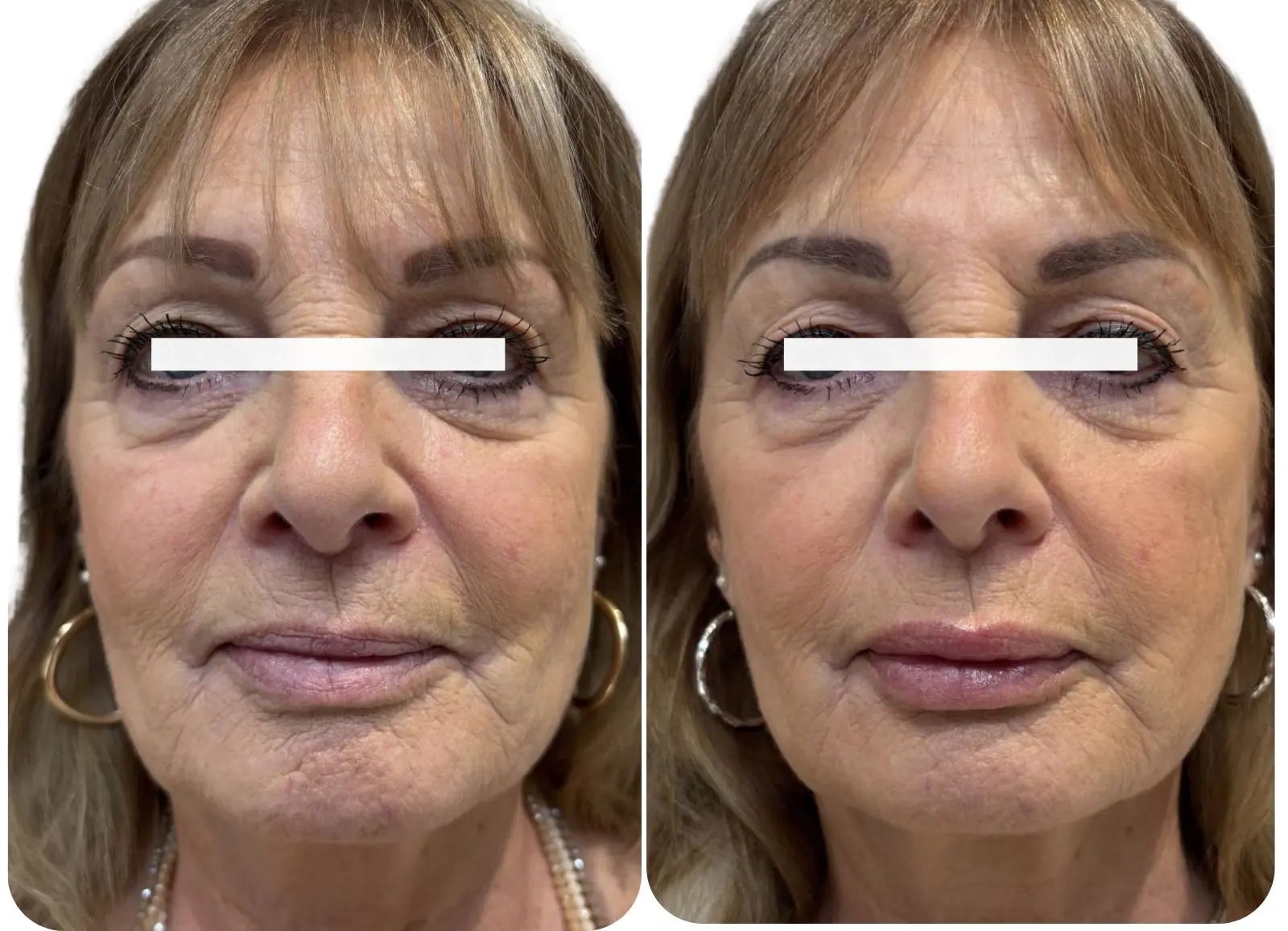 Avant et après injection d’acide hyaluronique dans les lèvres.