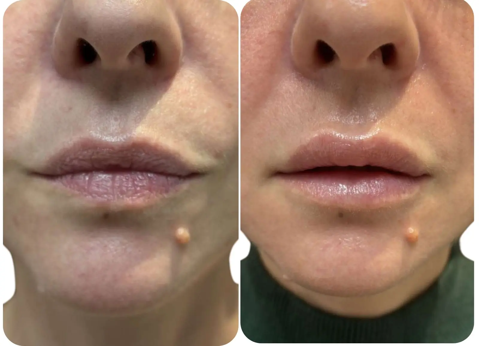 Avant/après injections d'acide hyaluronique dans les lèvres.
