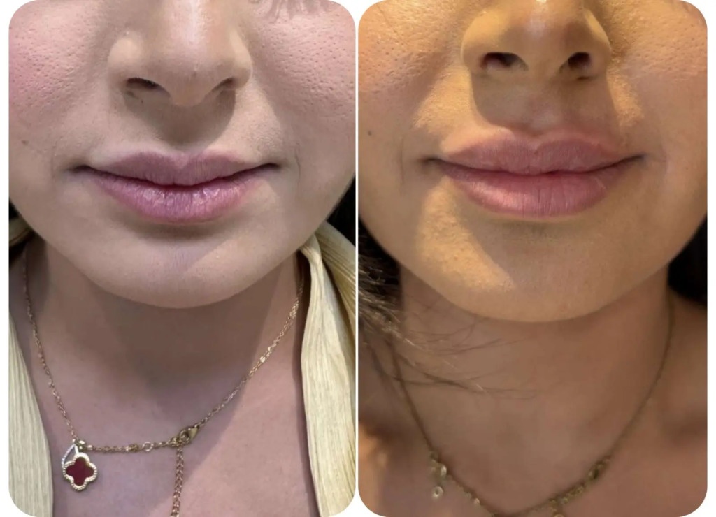 Avant et après injection d’acide hyaluronique dans les lèvres.