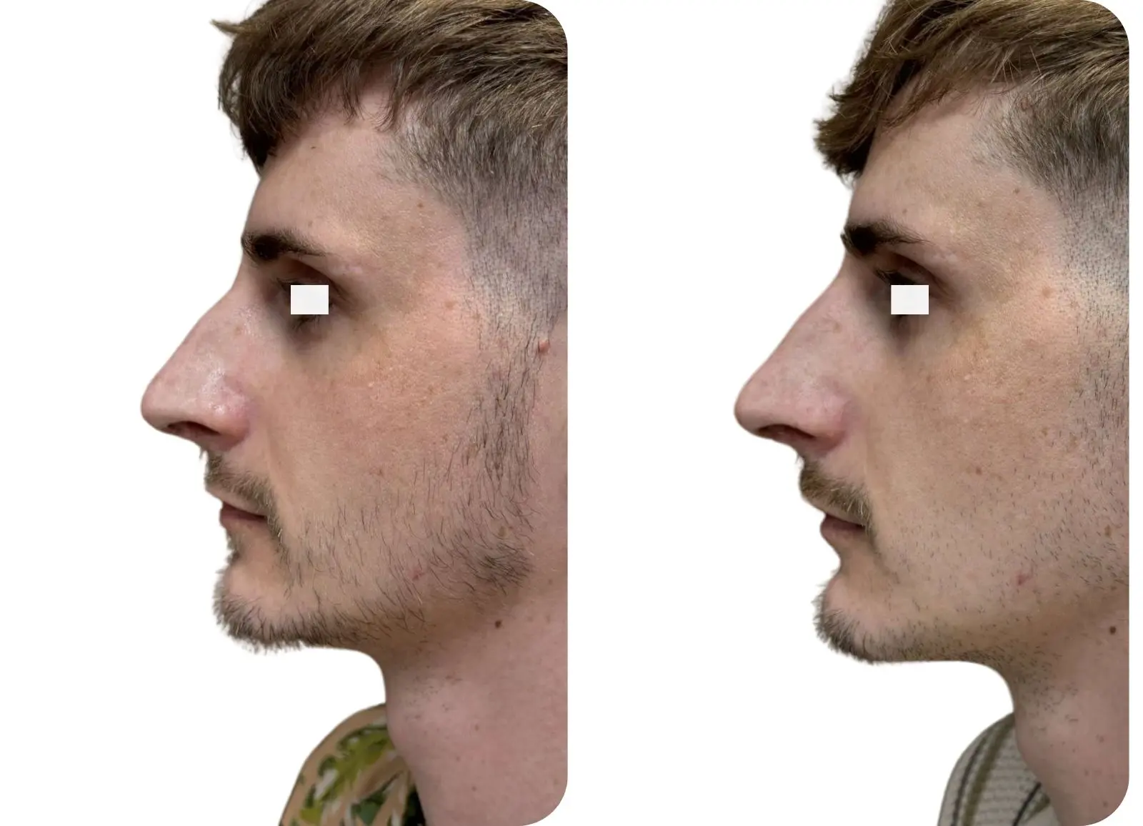 Acide hyaluronique - rhinoplastie médicale