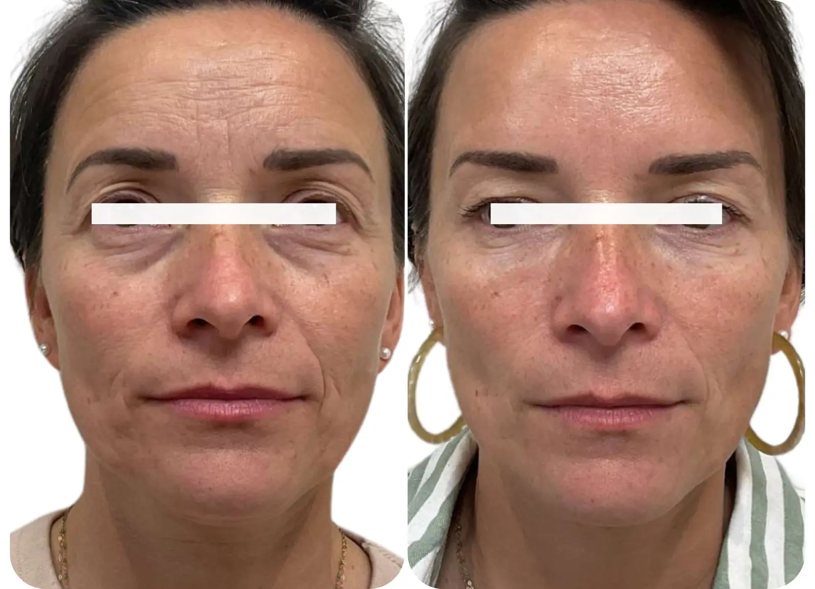 Avant/après injections d'acide hyaluronique au niveau des cernes.