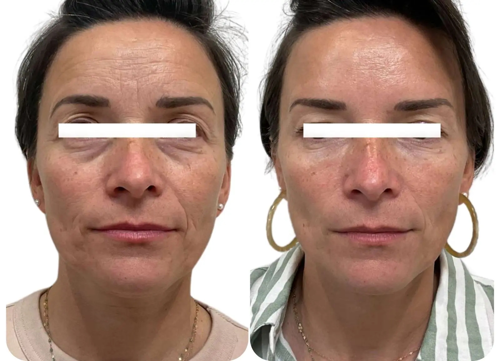 Résultat d’une injection d’acide hyaluronique dans les cernes.