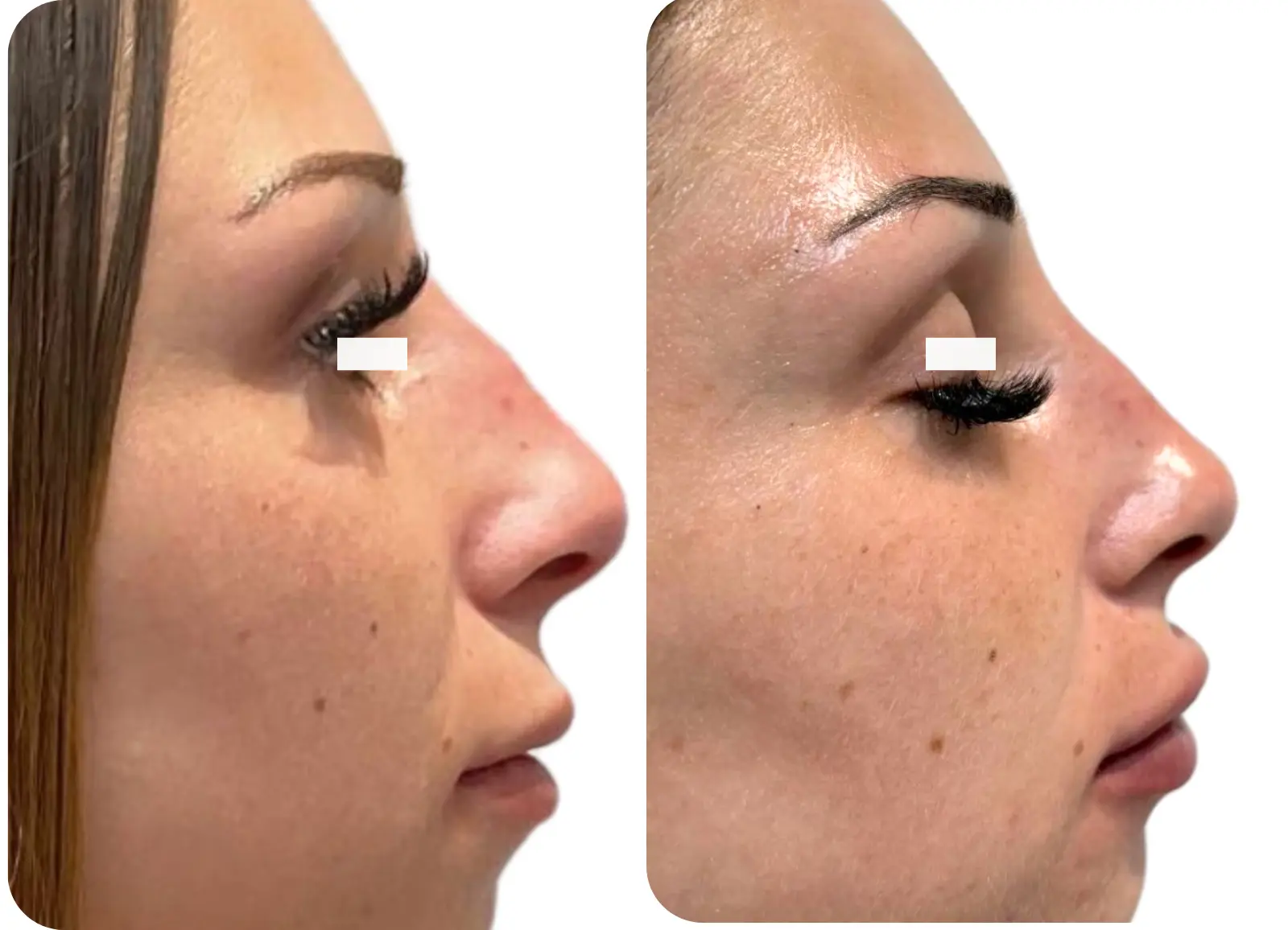 Avant et après correction du nez par acide hyaluronique.