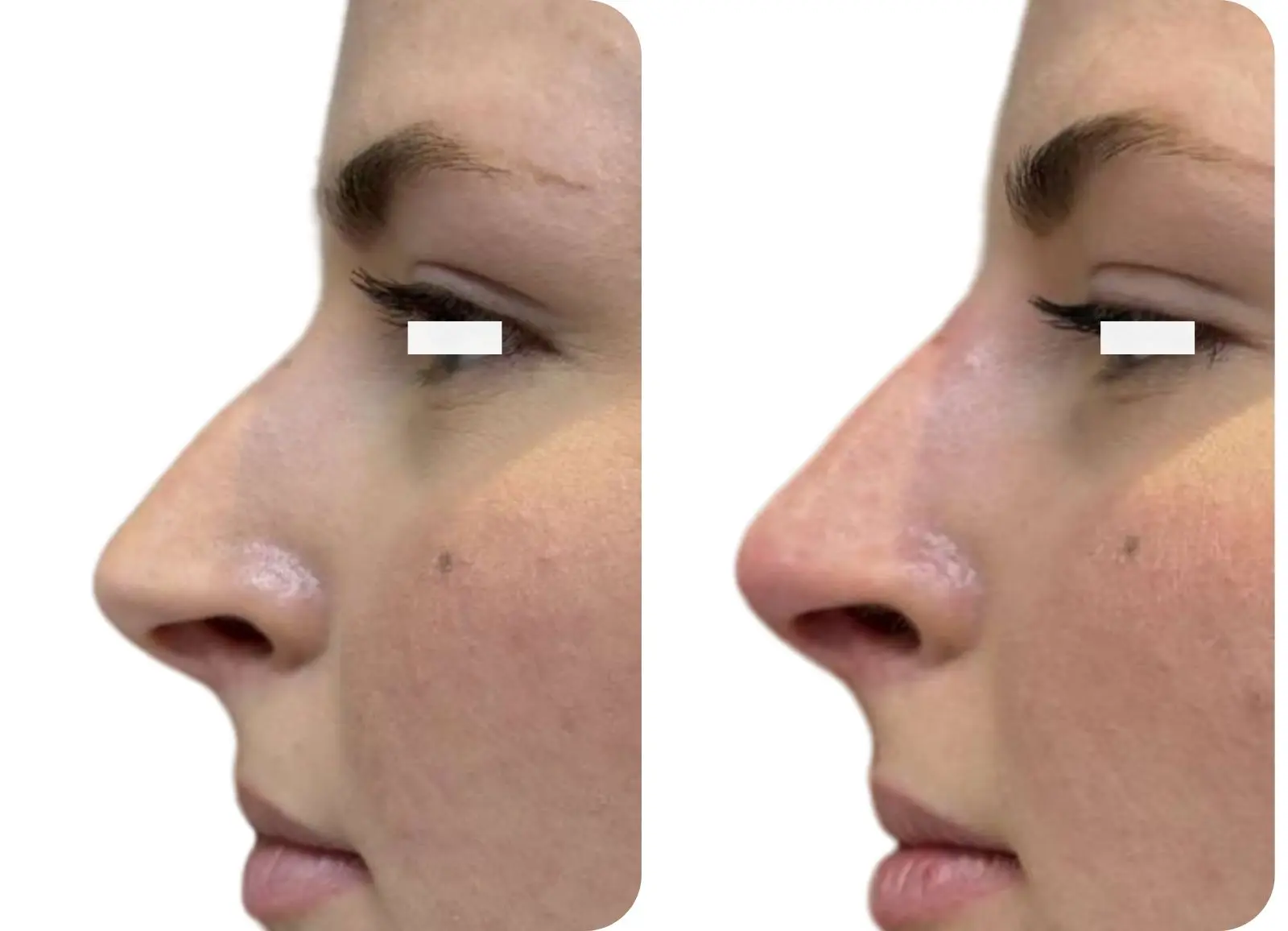 Acide hyaluronique - rhinoplastie médicale (2)