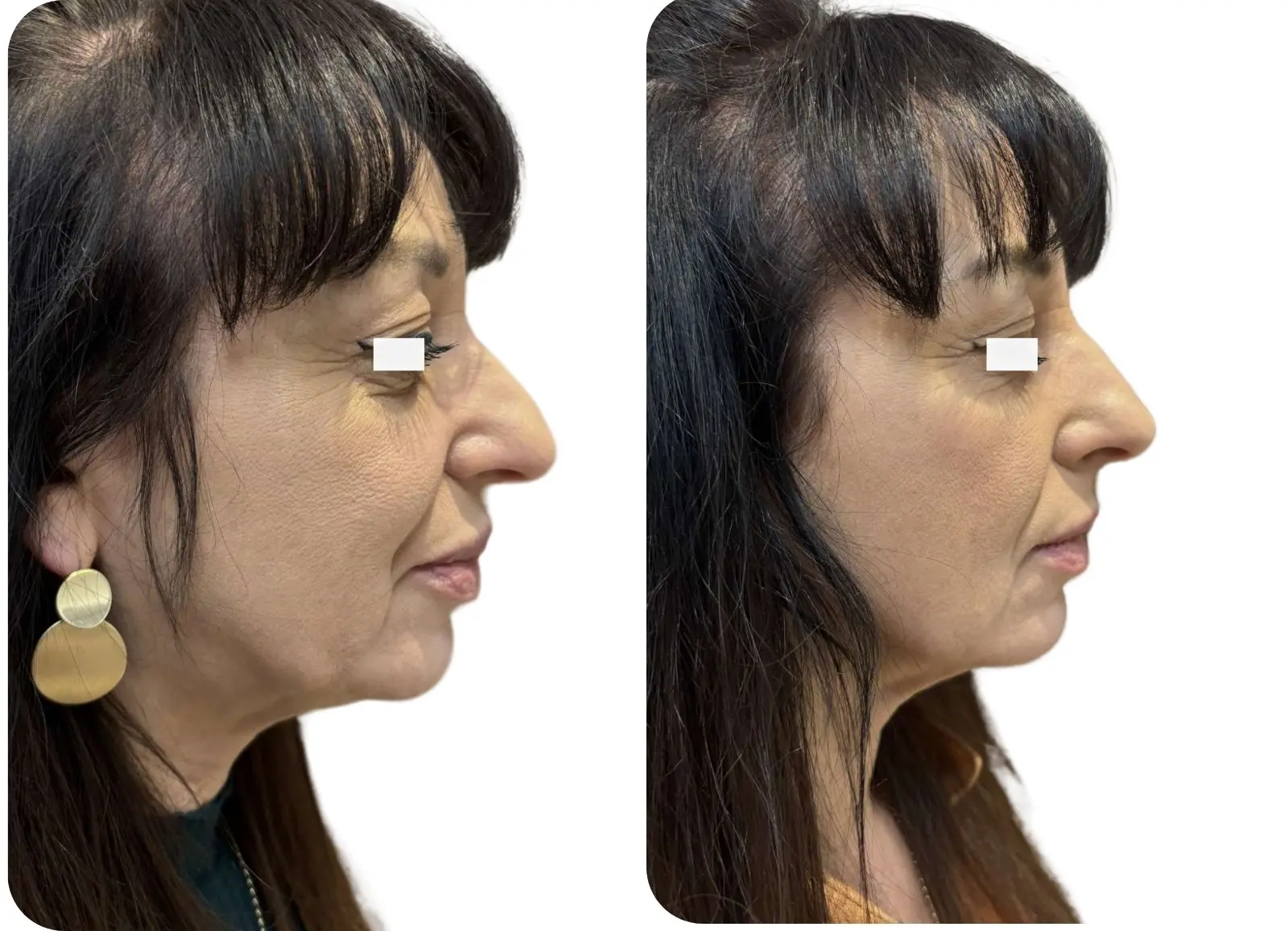 Acide hyarluronique - rhinoplastie médicale