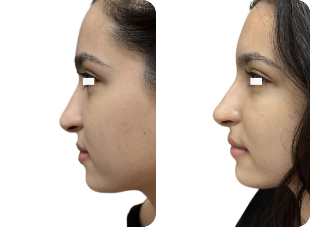Montage photo avant après montrant la correction d'une pointe de nez tombante grâce à des injections d'acide hyaluronique.