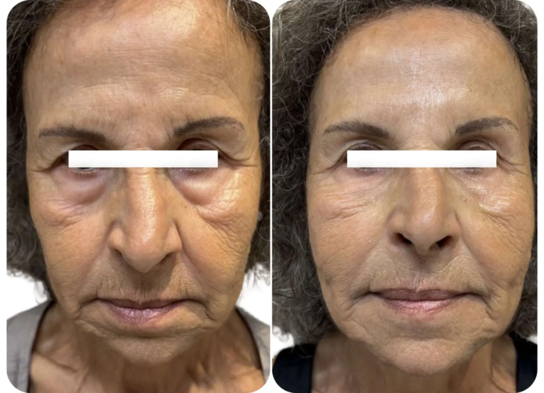 injection acide hyaluronique visage raté