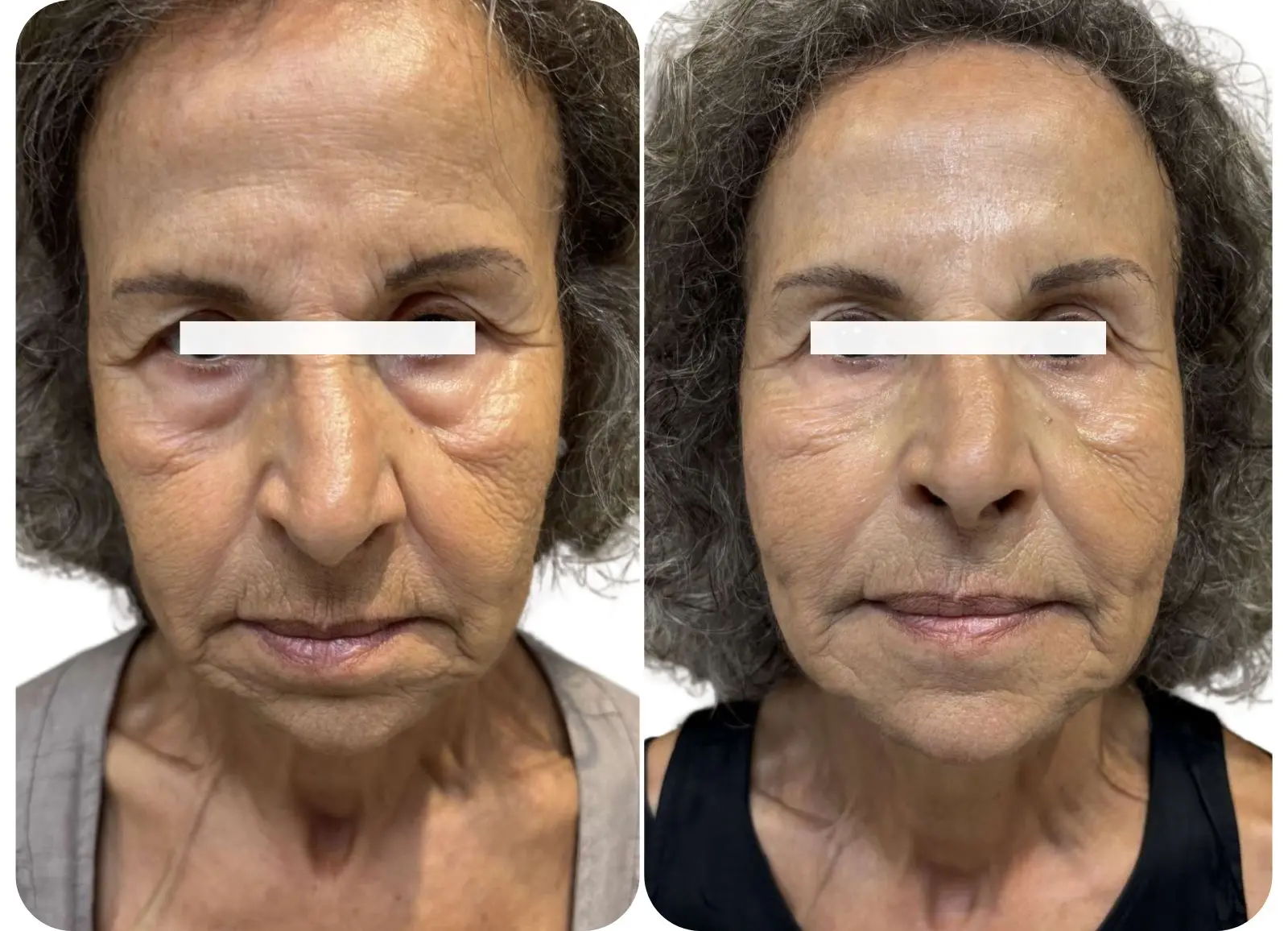 Avant/après injections d'acide hyaluronique dans la vallée des larmes et les sillons nasogéniens.