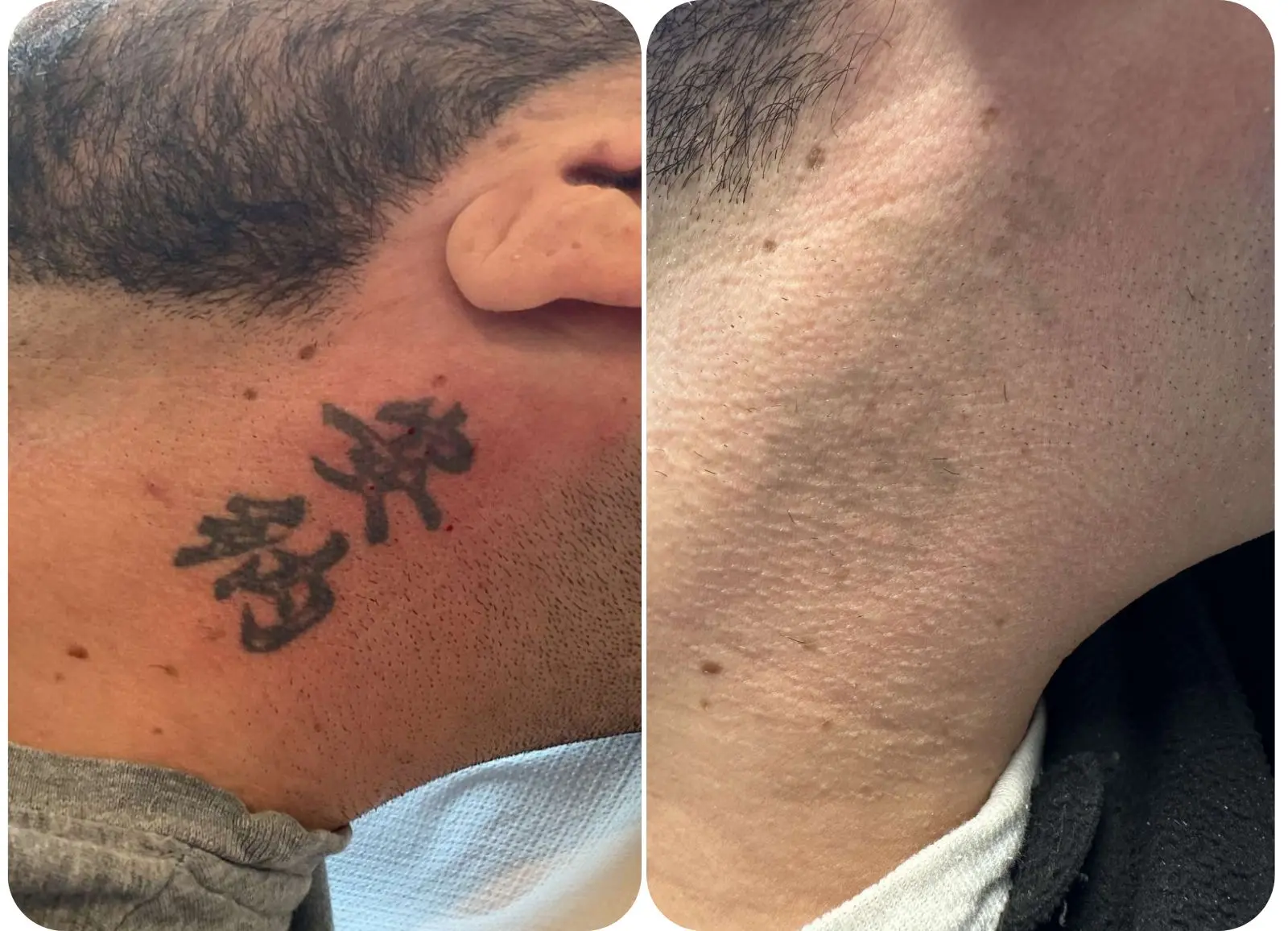 Détatouage laser