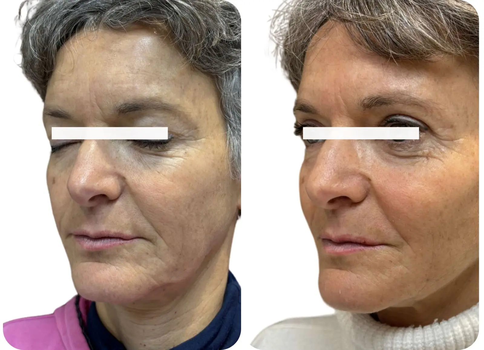 Avant et après pose de fils tenseurs visage.