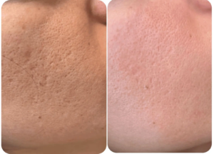 Avant et après laser Fraxel visage.