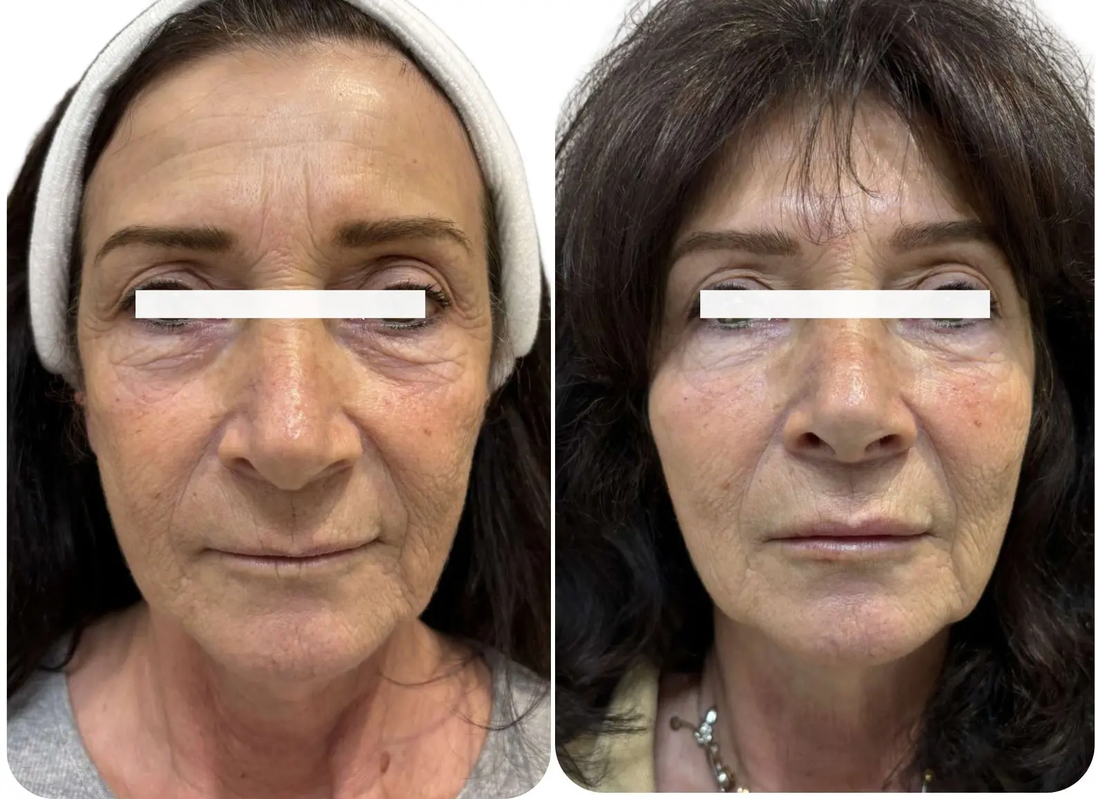 Avant/après d'injections d'acide hyaluronique