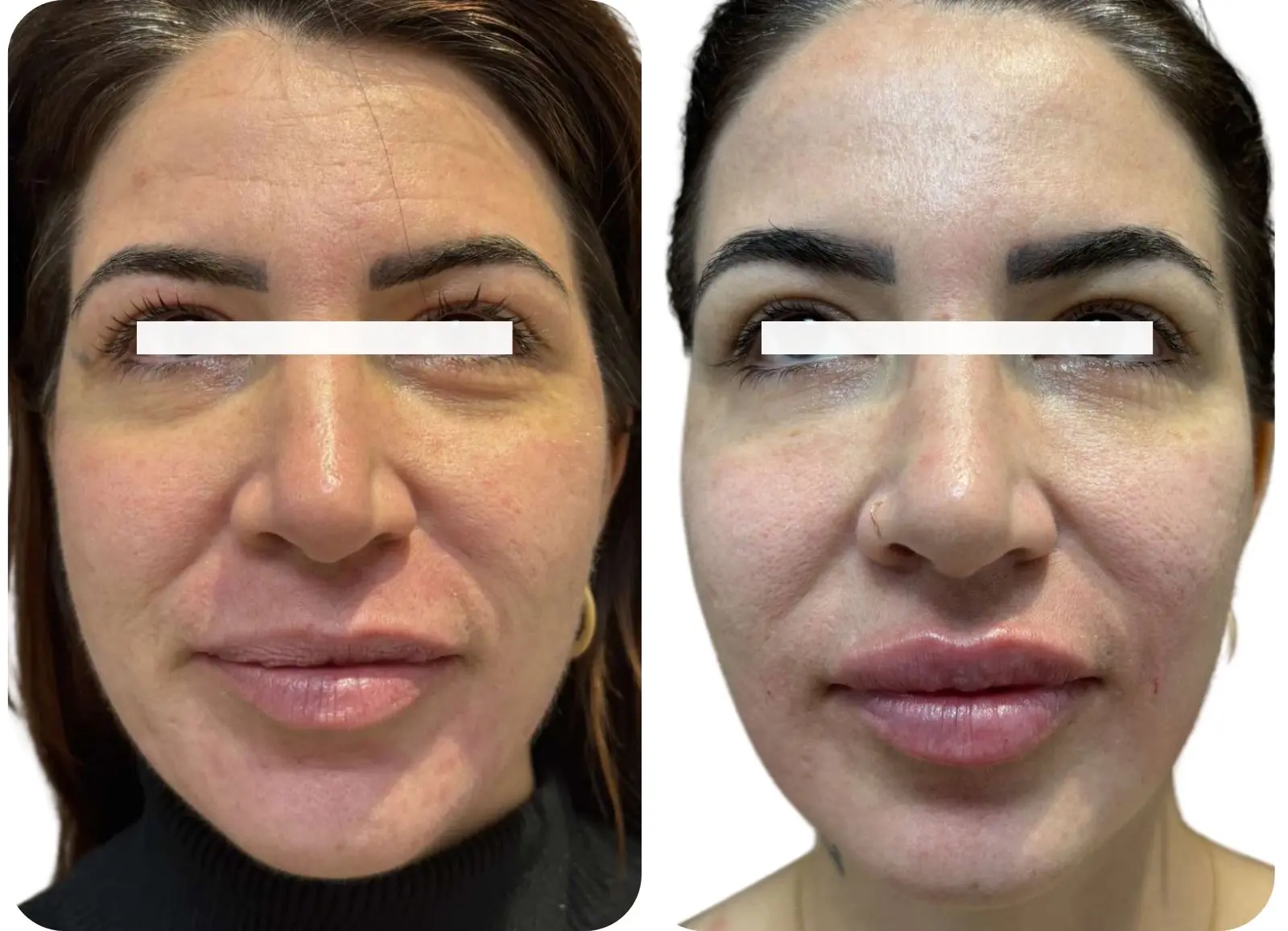 Avant/après injections d'acide hyaluronique lèvres.