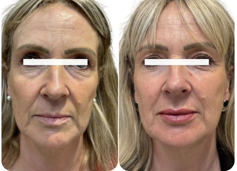 Avant et après laser Fraxel et acide hyaluronique lèvres.