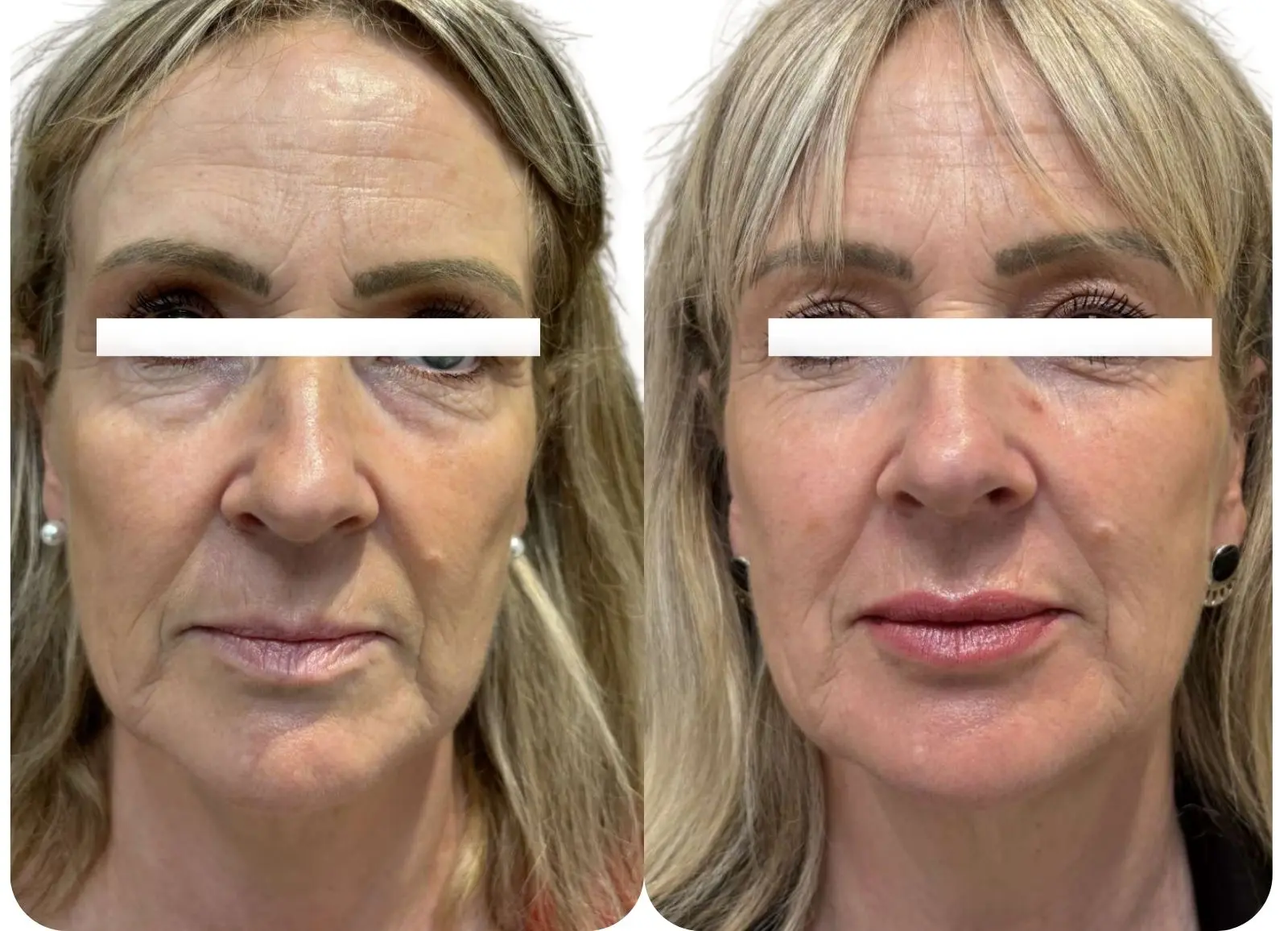 Fraxel visage + injection d'acide hyaluronique (lèvres)