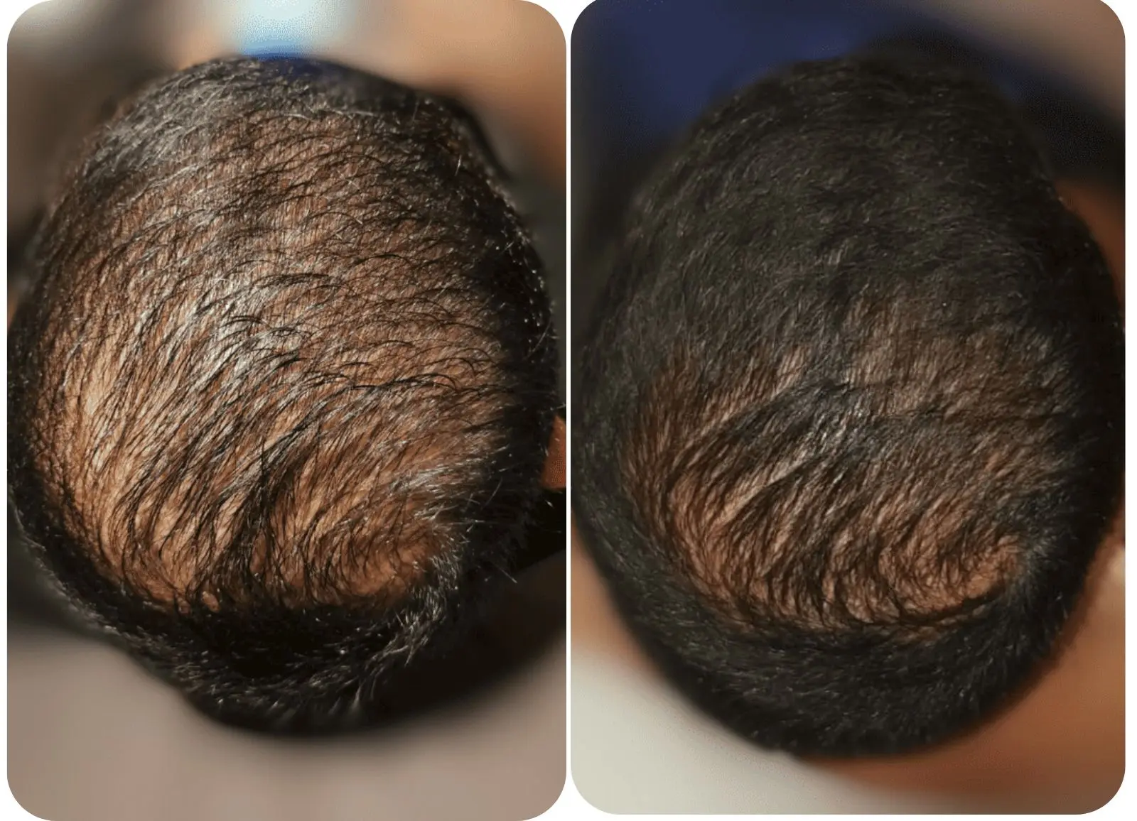 PRP - densité capillaire