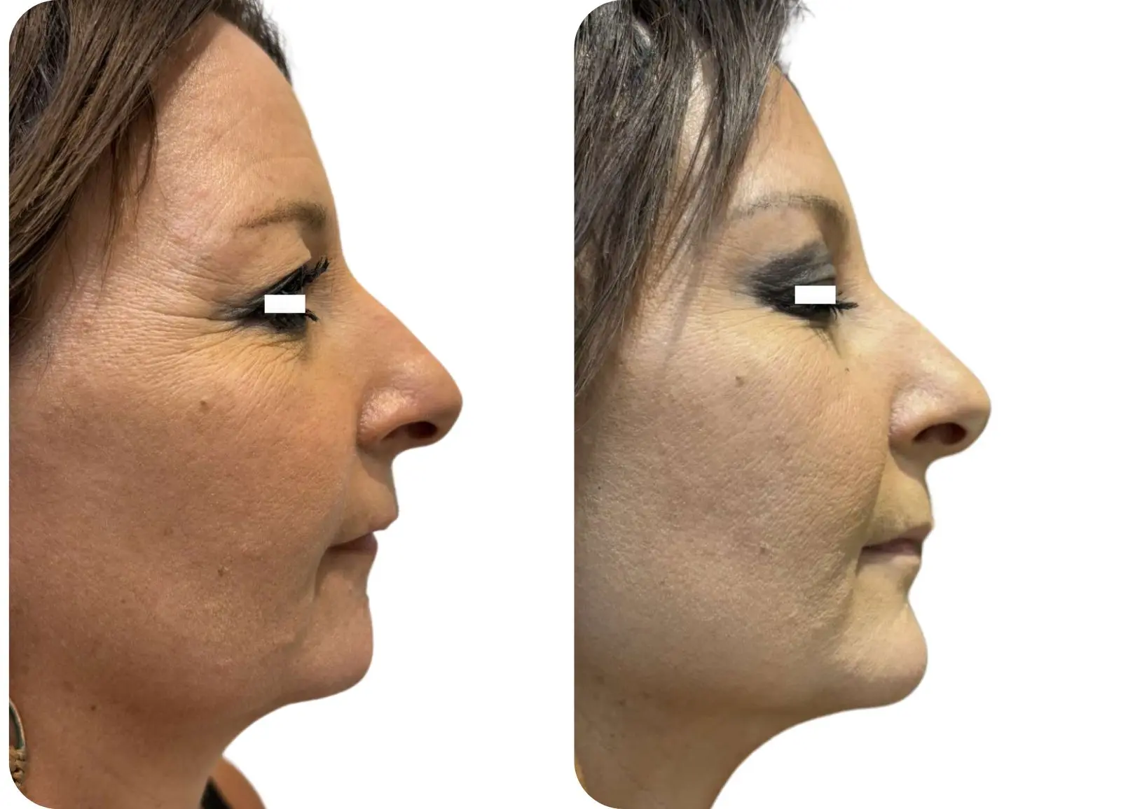 Profiloplastie - menton