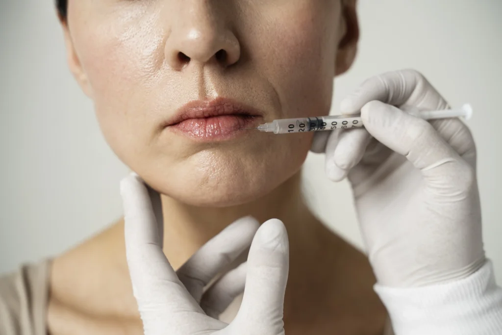 Gros plan d'une injection au coin de la bouche