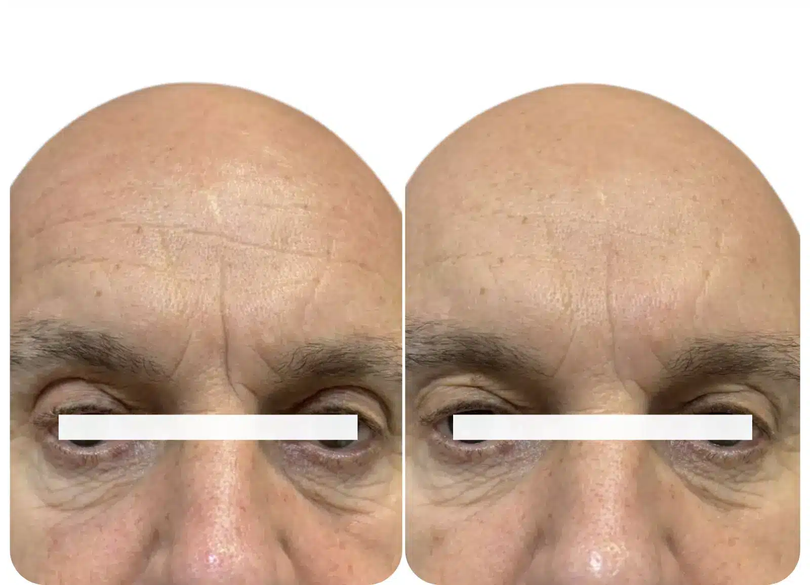 Photo avant après traitement des rides horizontales du front par injection d'acide hyaluronique.