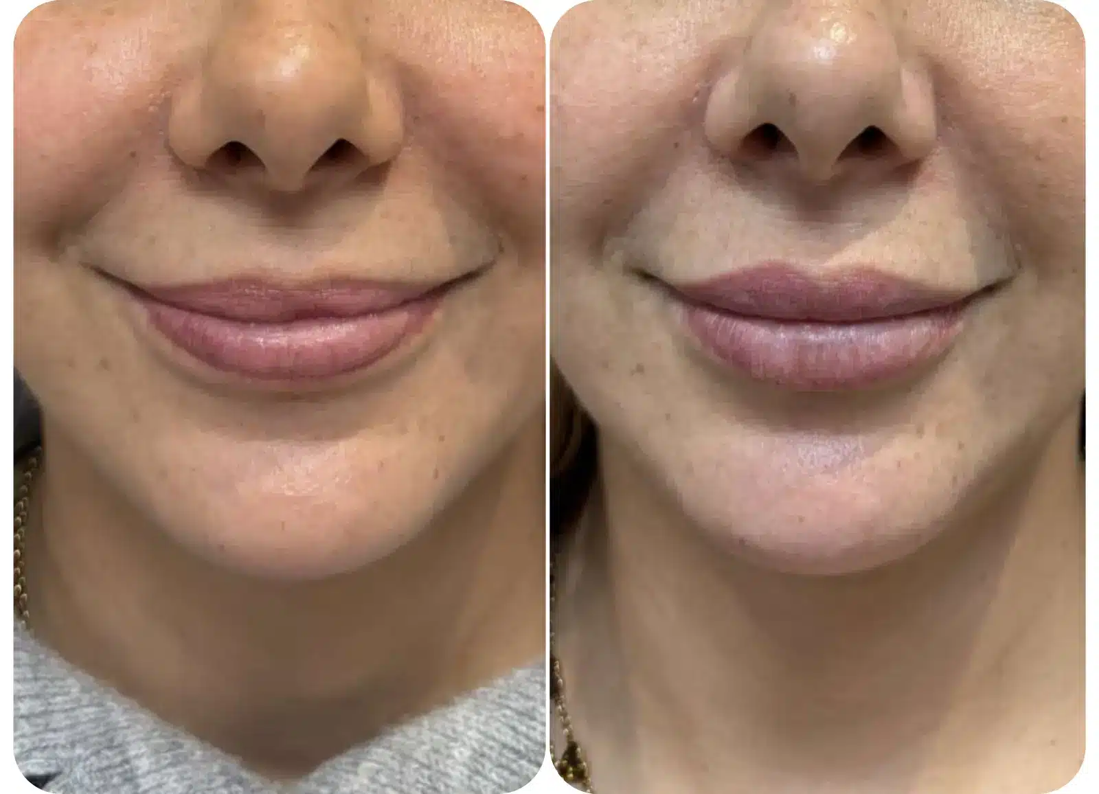 Photo avant après injection d'acide hyaluronique pour l'augmentation du volume et l'hydratation des lèvres.