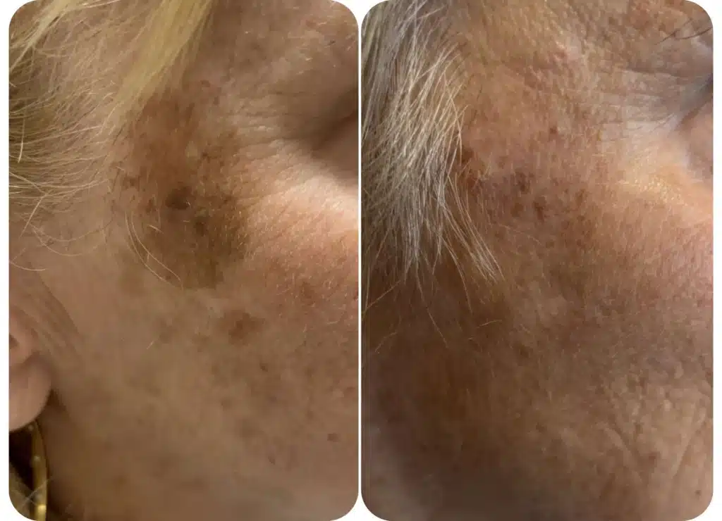 Photo avant après traitement des taches pigmentaires du visage avec le laser Spectra.