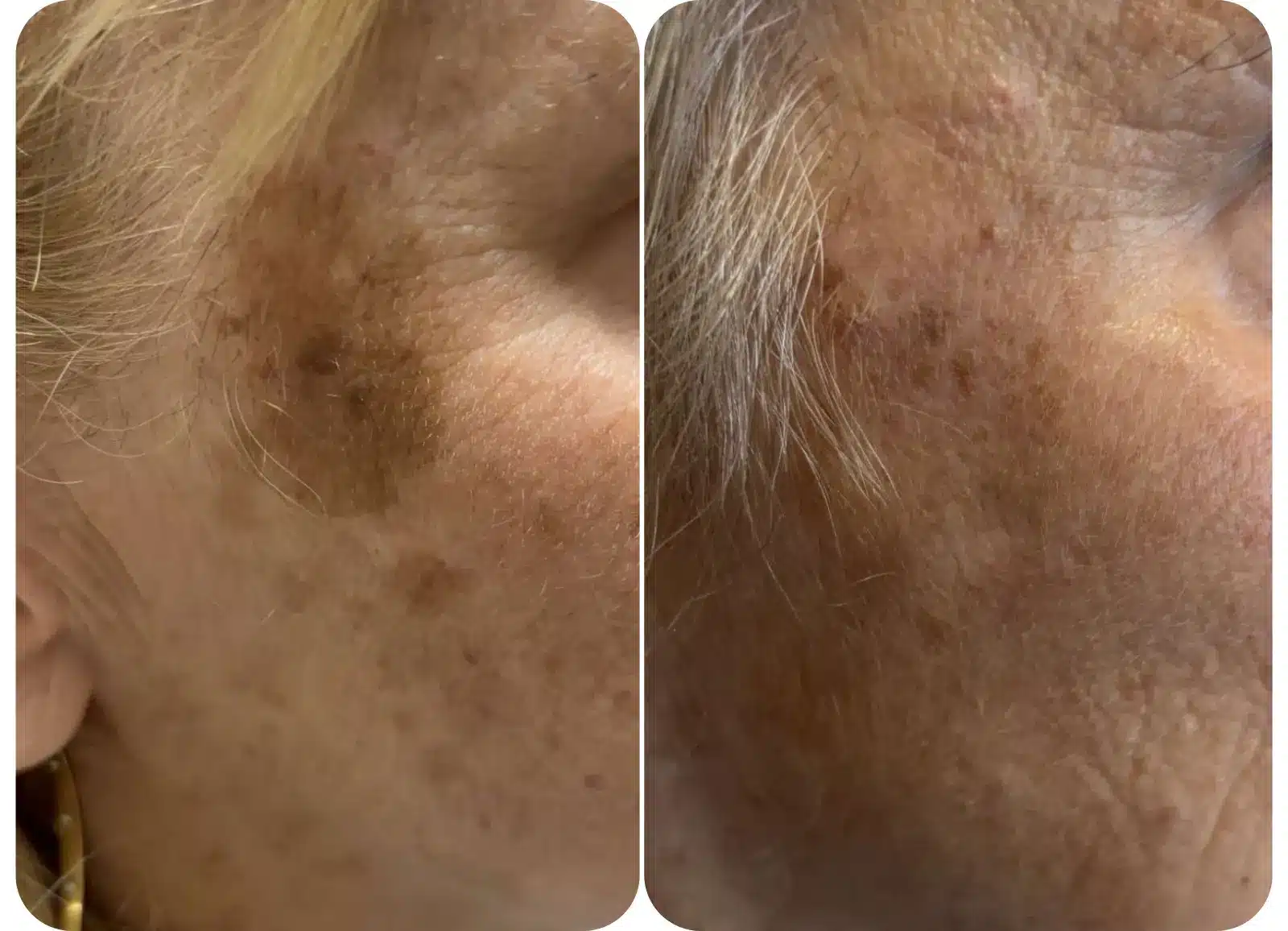 Photo avant après traitement des taches pigmentaires du visage avec le laser Spectra.