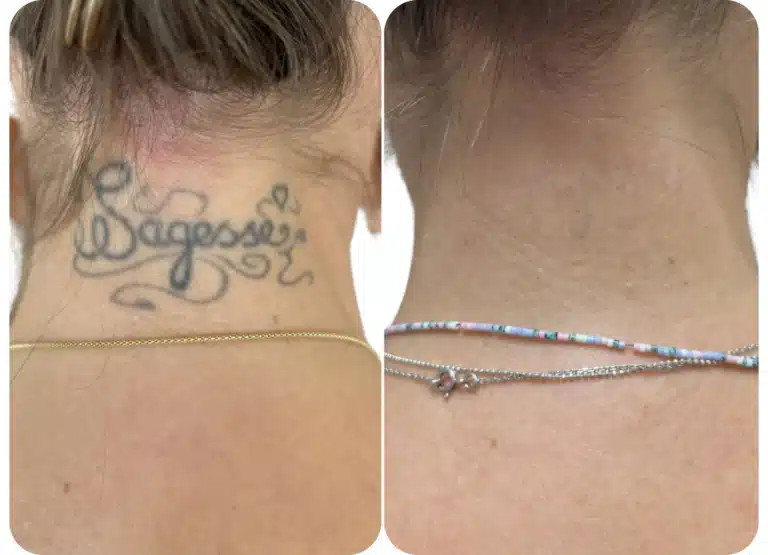 Photo avant après détatouage laser d'un tatouage noir sur la nuque après 5 séances.