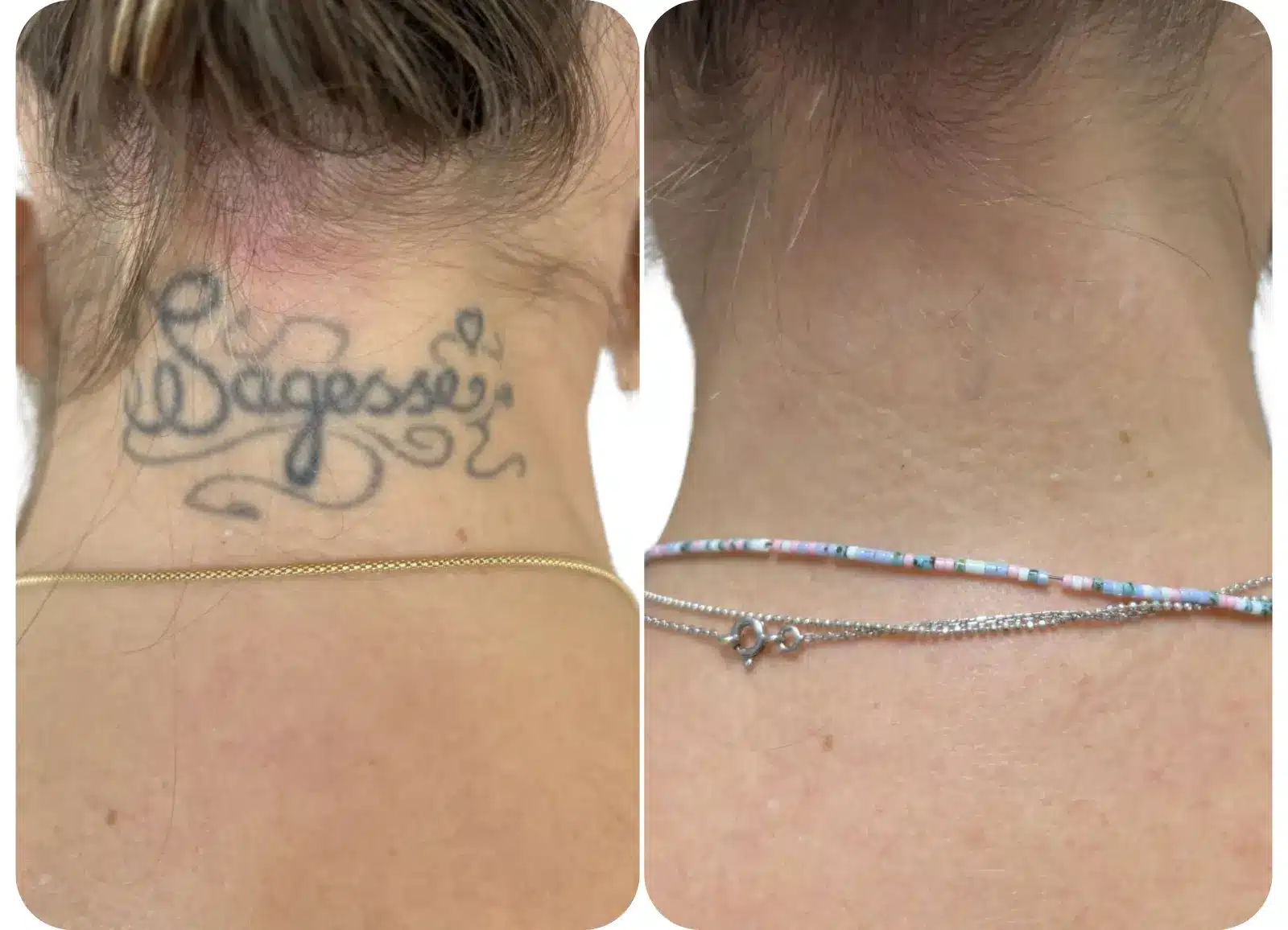 Photo avant après détatouage laser d'un tatouage noir sur la nuque après 5 séances.