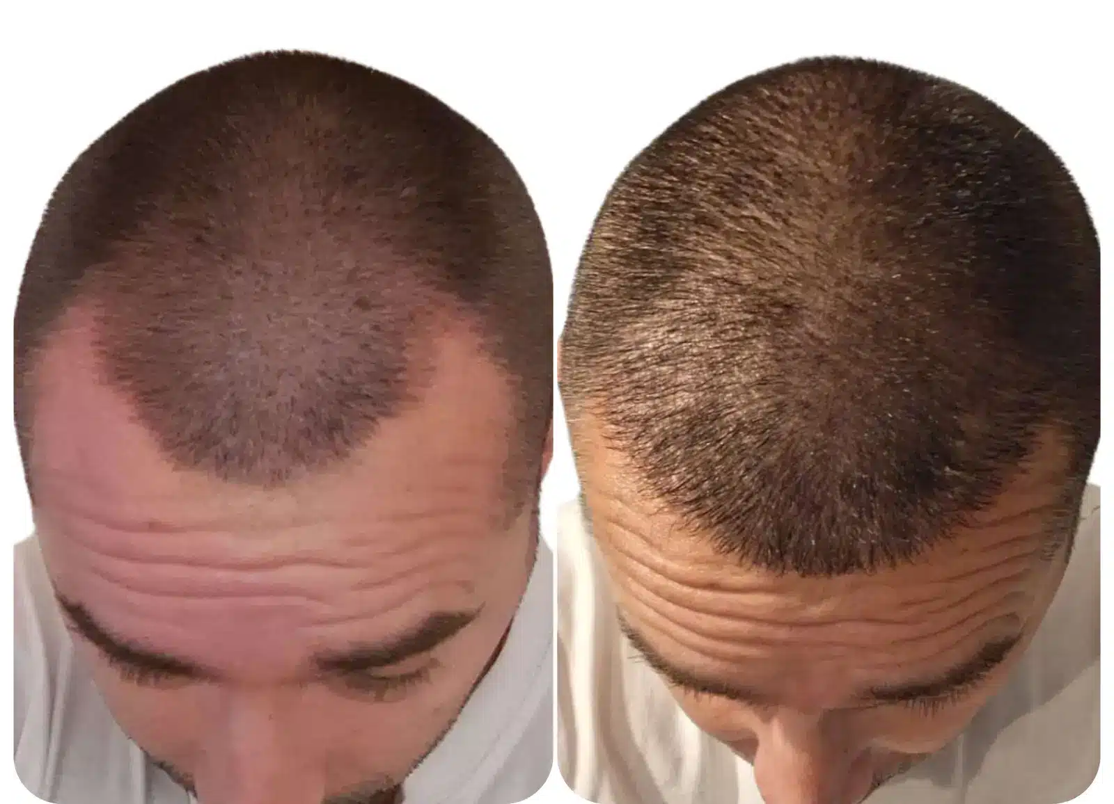 Photo avant après le résultat d'une greffe capillaire (implants de cheveux) pour corriger une calvitie.