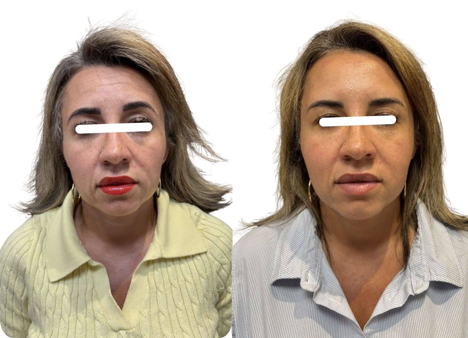 Harmonisation globale du visage (full face - cernes, pommettes)