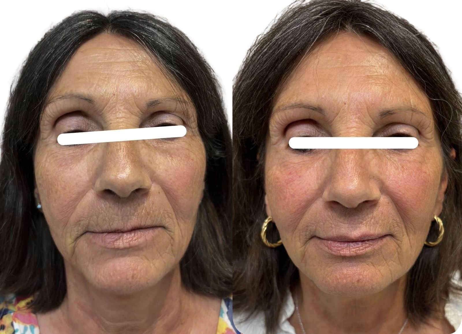 Harmonisation tiers moyen/inférieur visage - Acide Hyaluronique