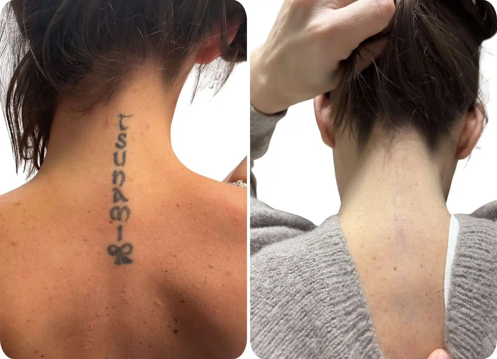 Détatouage Laser - Après 6 séances