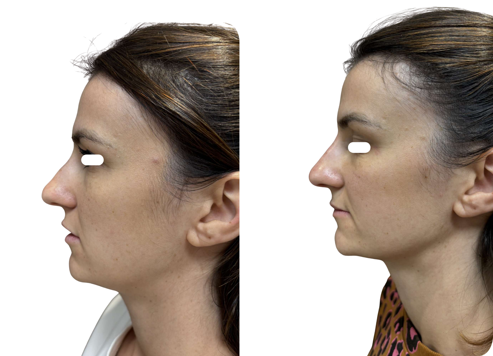 Rhinoplastie médicale avant/après (acide hyaluronique)