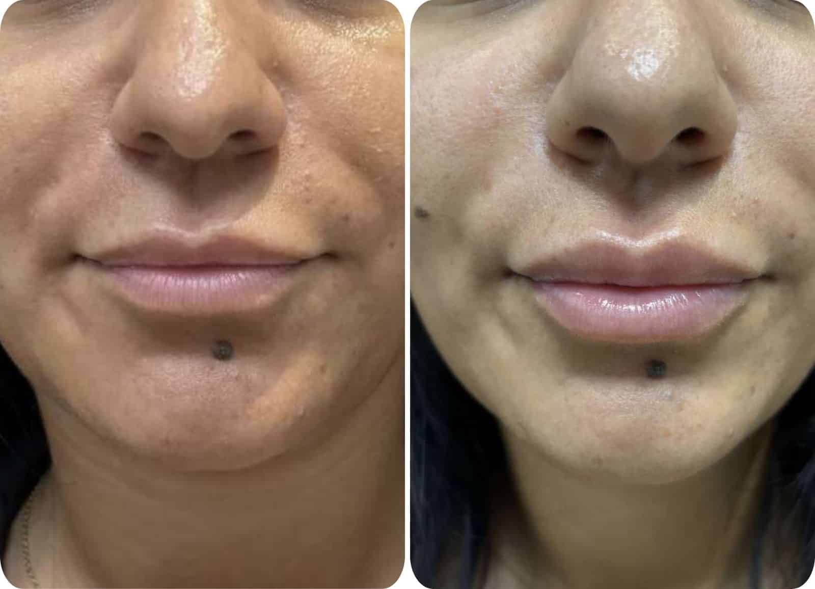 Résultat avant et après injection d’acide hyaluronique dans les lèvres.