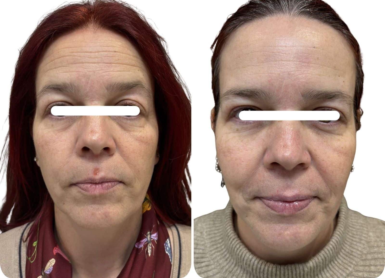 Acide hyaluronique "full face" - Avant/après