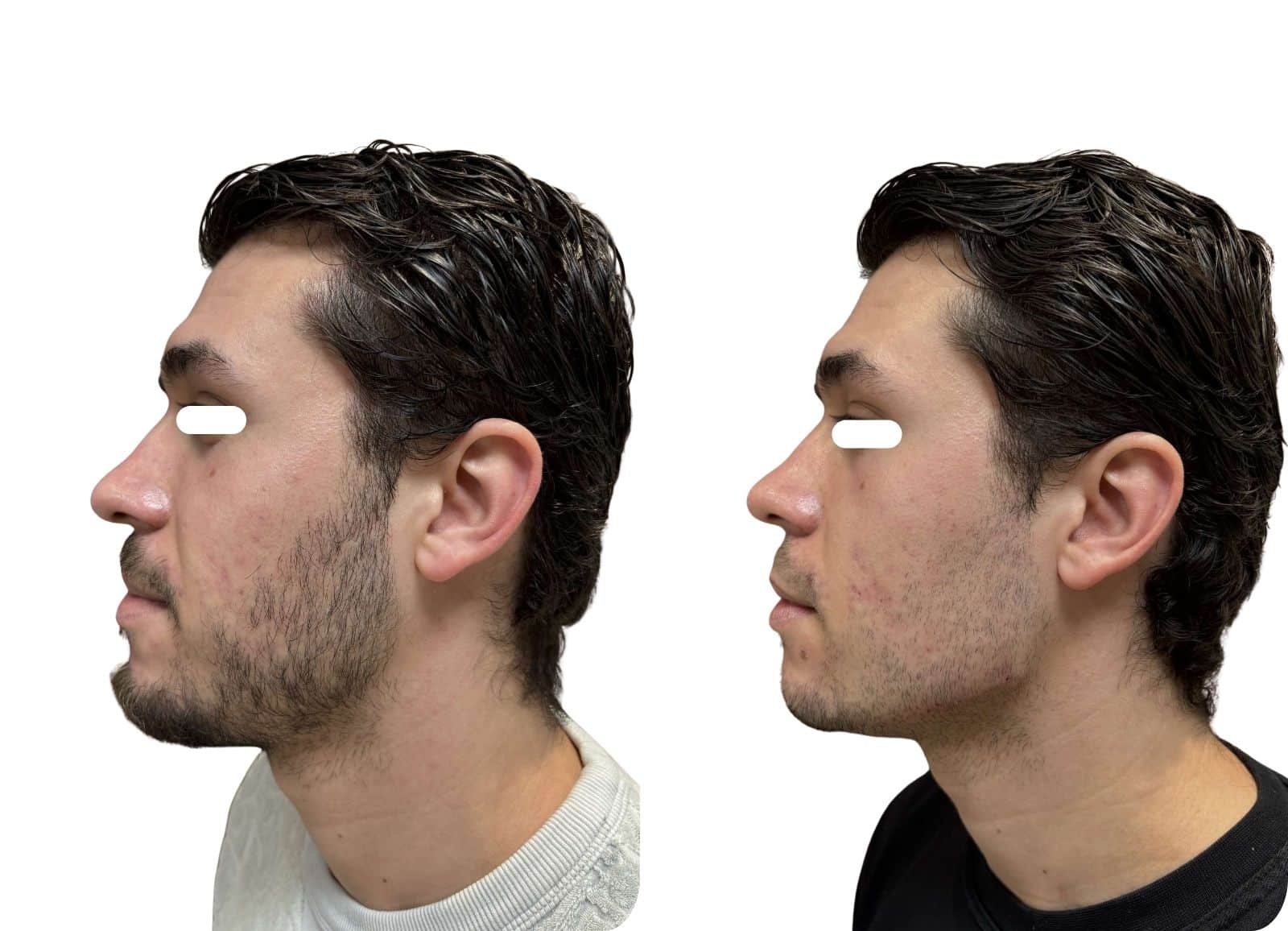Injection acide hyaluronique Jawline