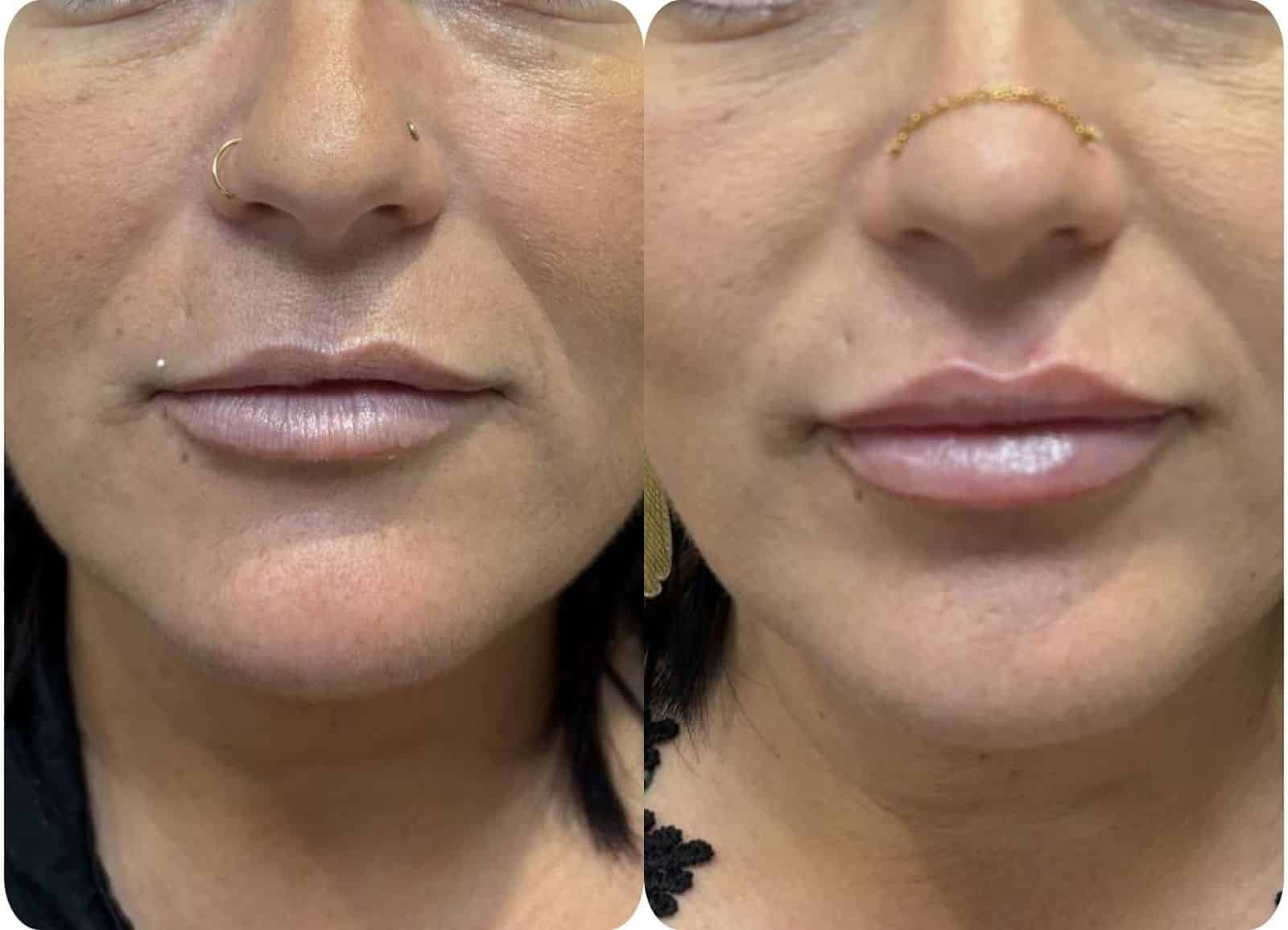 Injection lèvres acide hyaluronique - Russian Lips