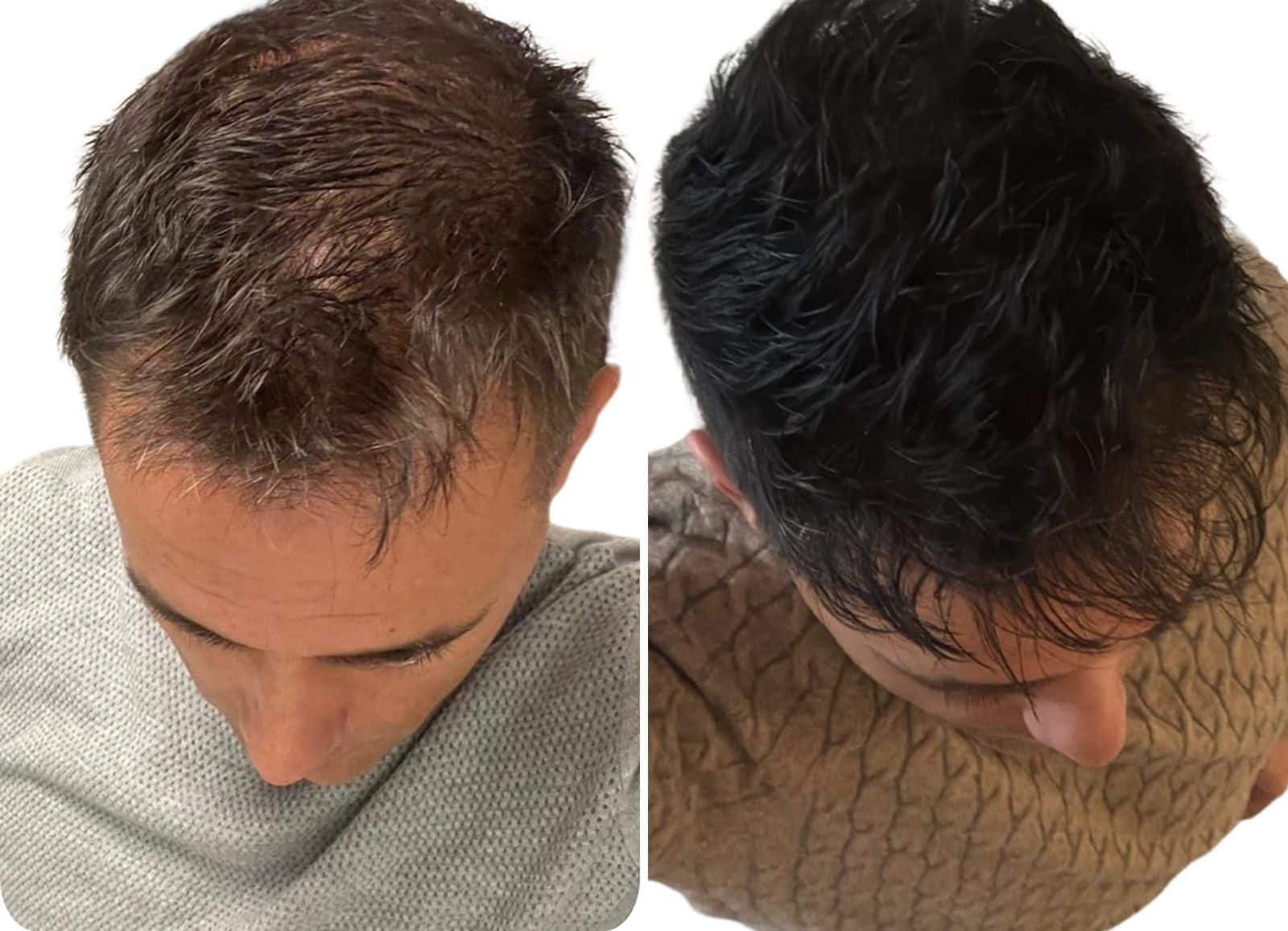 Avant/après greffe capillaire