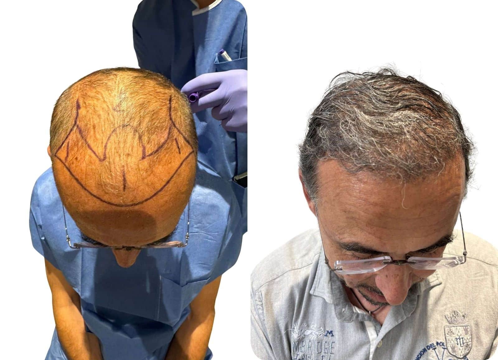 Avant/après greffe capillaire