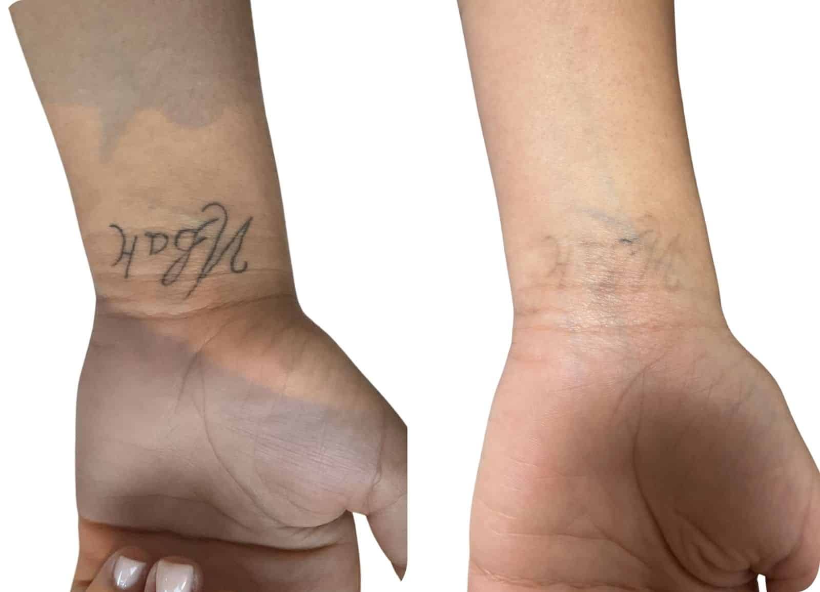 Détatouage - Après 5 séances